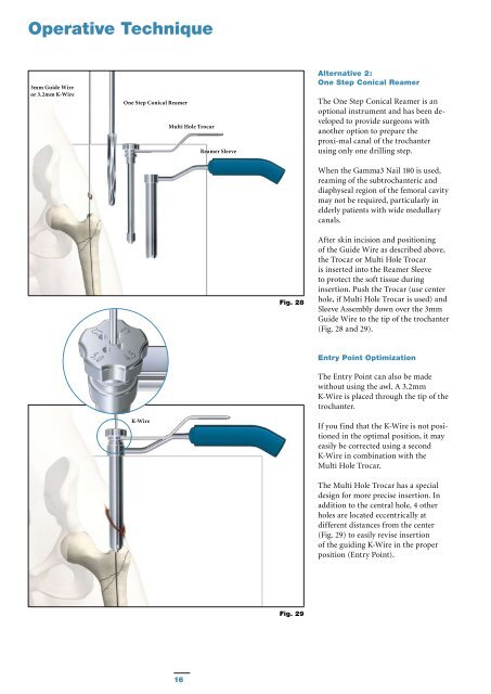 Gamma3 Trochanteric Nail 180 - Stryker