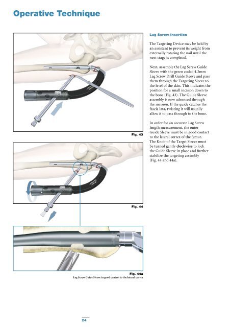 Gamma3 Trochanteric Nail 180 - Stryker