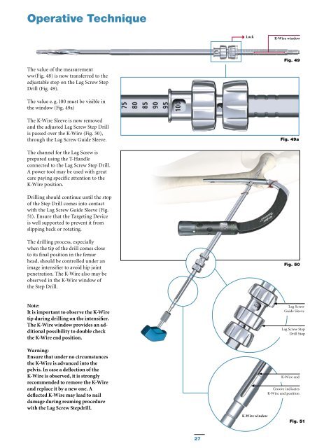 Gamma3 Trochanteric Nail 180 - Stryker