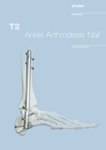 T2 Ankle Arthrodesis Nail - Stryker