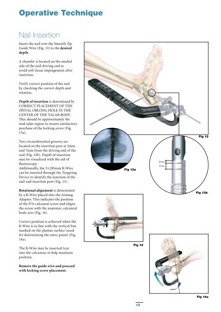 T2 Ankle Arthrodesis Nail - Stryker