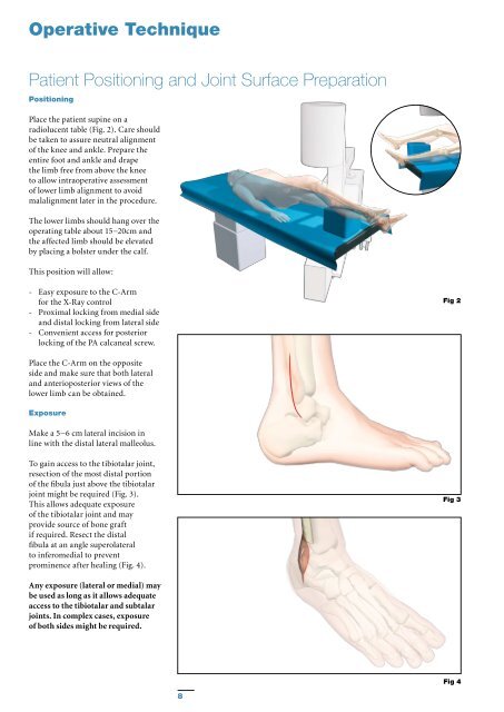 T2 Ankle Arthrodesis Nail - Stryker