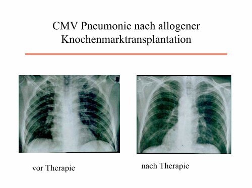 CMV Pneumonie nach Transplantation: Aktuelle Prophylaxe und ...