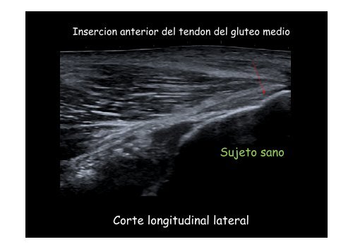 UltrasonografÃ­a de cadera - panlar