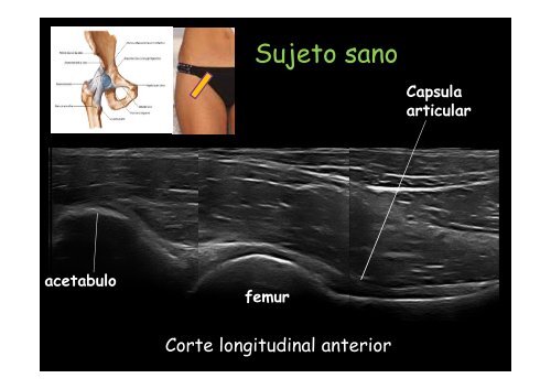 UltrasonografÃ­a de cadera - panlar