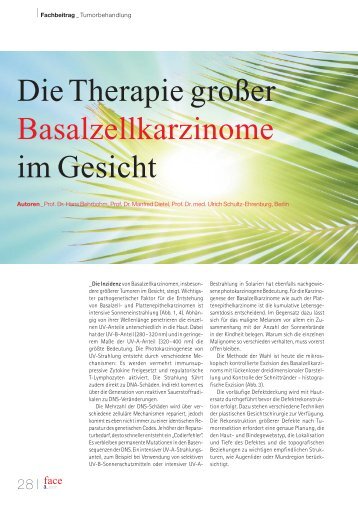 Die Therapie groÃer Basalzellkarzinome im Gesicht - Park Klinik ...