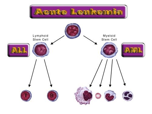 Leukemia Lecture Part 1 - Pathology