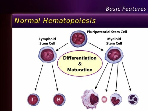 Leukemia Lecture Part 1 - Pathology