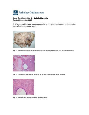 contributed by Dr. Najla Fakruddin - Pathology Outlines