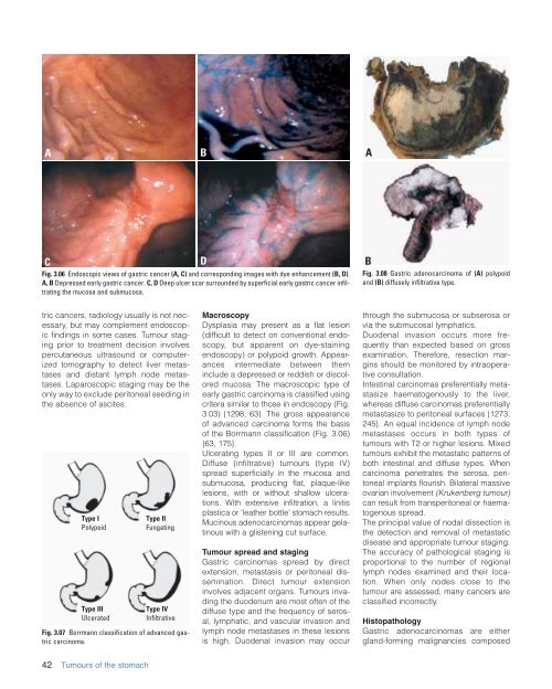 CHAPTER 3 Tumours of the Stomach - Pathology Outlines