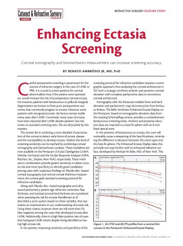 Enhancing Ectasia Screening - Oculus