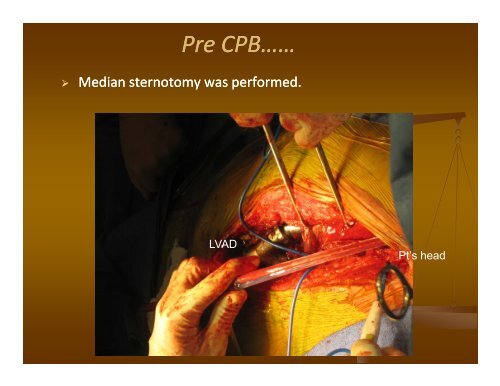 PowerPoint Presentation (PDF) - Perfusion.com