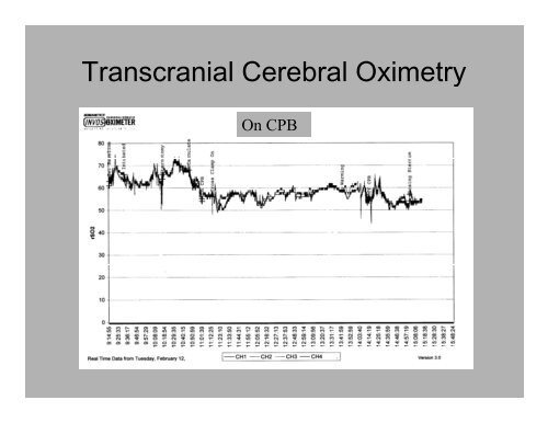 PowerPoint Presentation (PDF) - Perfusion.com