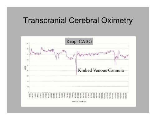 PowerPoint Presentation (PDF) - Perfusion.com