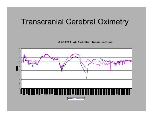 PowerPoint Presentation (PDF) - Perfusion.com