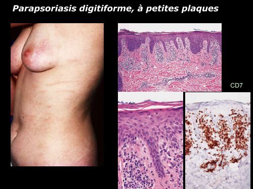 Lymphome centro-folliculaire primitif cutané - epathologies