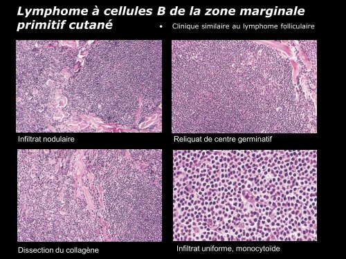 Lymphome centro-folliculaire primitif cutané - epathologies