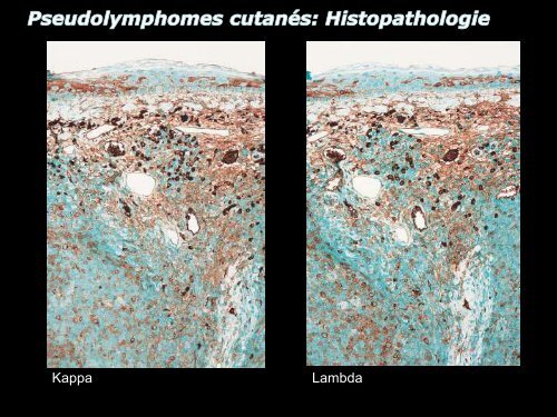 Lymphome centro-folliculaire primitif cutané - epathologies