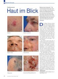 Hauttumoren - Plastische Chirurgie Dr. Reus