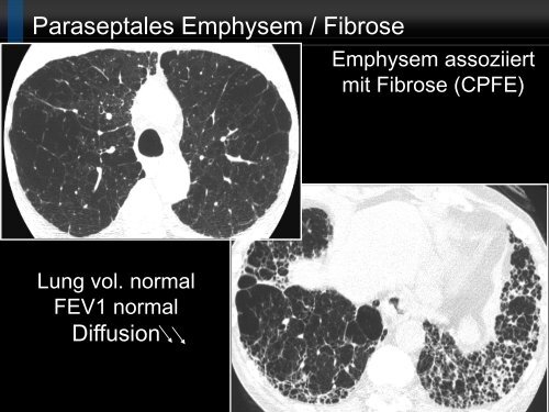 Bildgebung und COPD