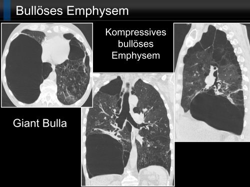 Bildgebung und COPD