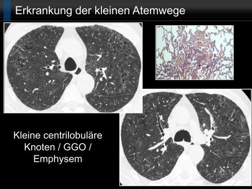 Bildgebung und COPD