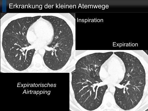 Bildgebung und COPD