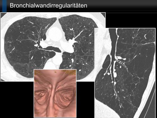 Bildgebung und COPD