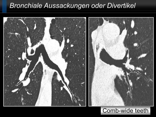 Bildgebung und COPD