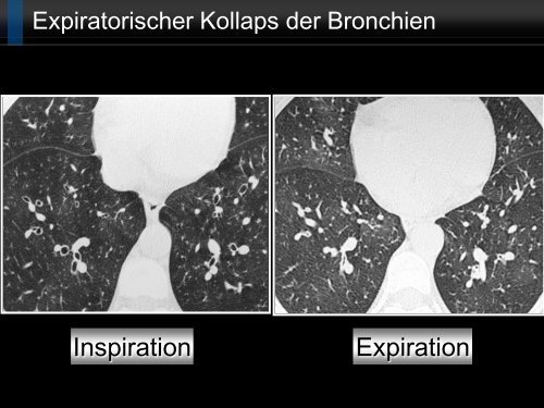 Bildgebung und COPD