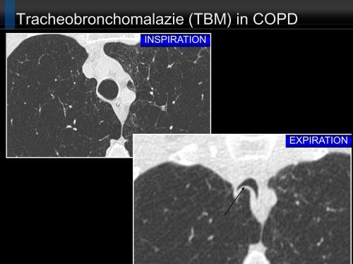 Bildgebung und COPD