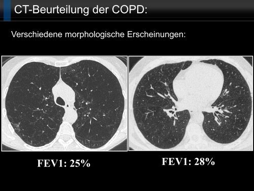 Bildgebung und COPD