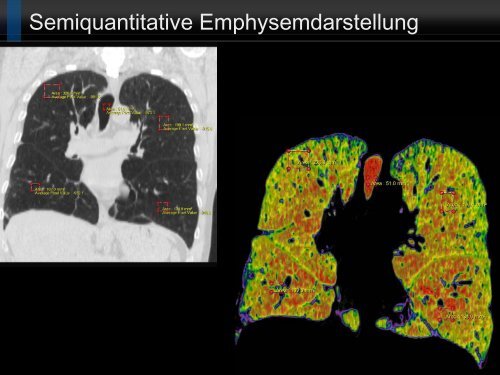 Bildgebung und COPD