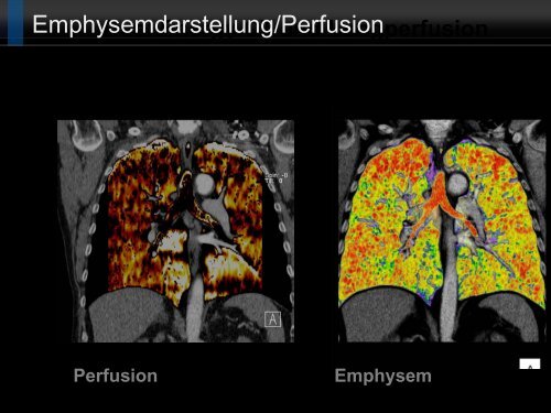 Bildgebung und COPD