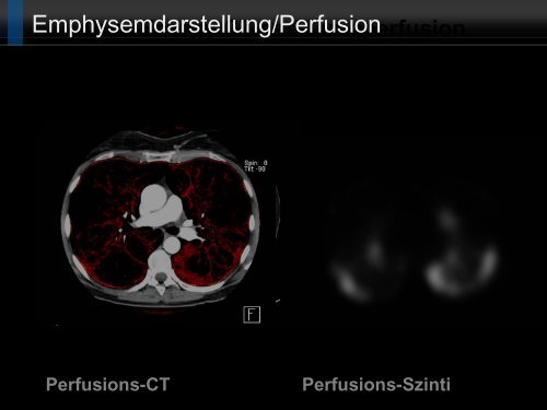 Bildgebung und COPD