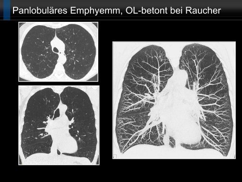 Bildgebung und COPD