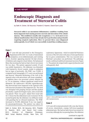 Endoscopic Diagnosis and Treatment of Stercoral Colitis - Practical ...