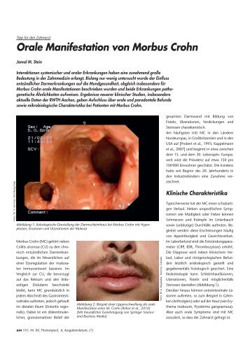 Orale Manifestation von Morbus Crohn - ZahnÃ¤rztliches ...