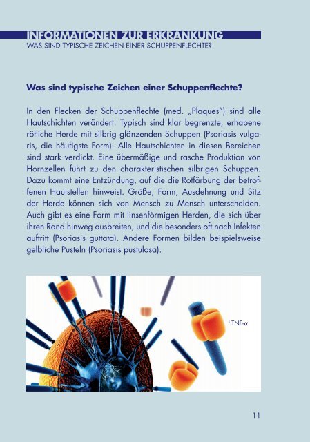 InfORmAtIOnen zuR eRkRAnkung - Psoriasis