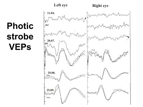 Visuell evozierte Potenziale als Mittel der funktionellen Diagnostik