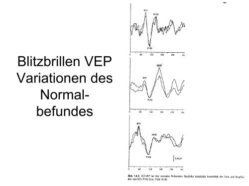 Visuell evozierte Potenziale als Mittel der funktionellen Diagnostik