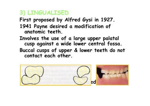 balanced occlusion