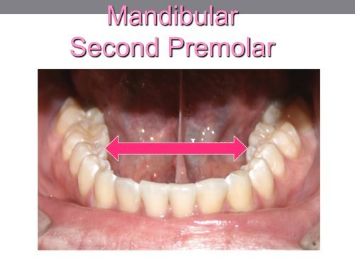 Mandibular PREMOLARS