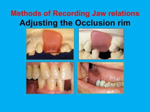 Methods of Recording Jaw relations