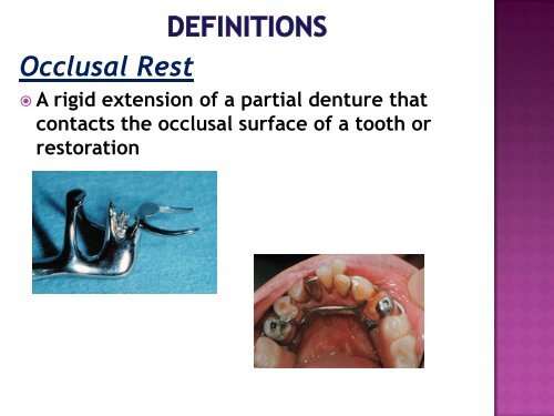 Occlusal Rest