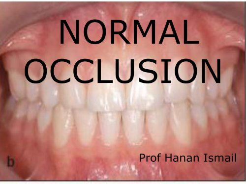 NORMAL OCCLUSION