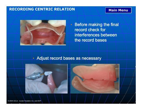 Inadequate Interocclusal Inadequate Interocclusal Rest Space ...