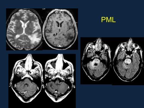 Neuroimaging Christopher Bever, MD, MBA (MODERATOR) Use of ...