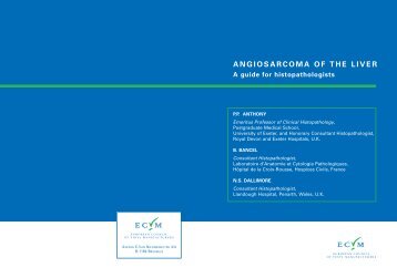 Angiosarcoma of the liver, A guide for histopathologists - PVC