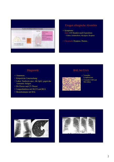 Exogen allergische Alveolitis Akute exogen all. Alveolitis ...